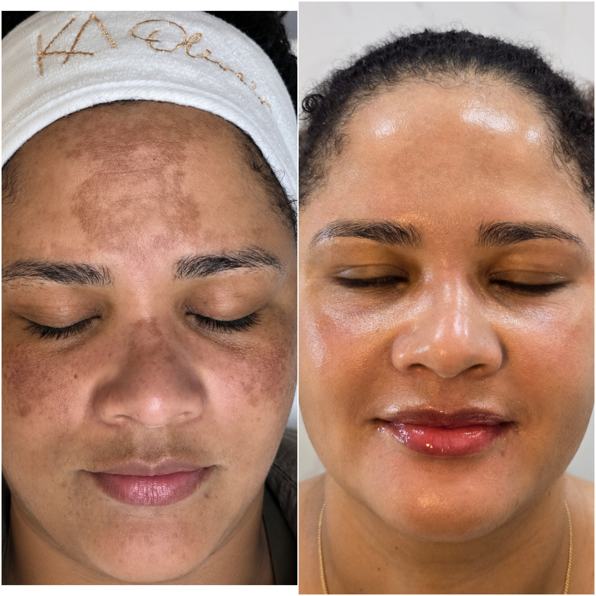 Melasma e manchas